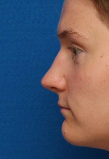 Rhinoplasty After Photo by Christopher Derderian, MD; Dallas, TX - Case 47668
