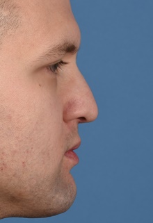 Rhinoplasty After Photo by Christopher Derderian, MD; Dallas, TX - Case 47669