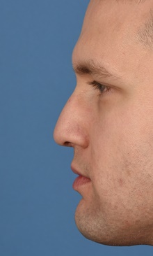 Rhinoplasty After Photo by Christopher Derderian, MD; Dallas, TX - Case 47669
