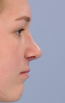 Rhinoplasty After Photo by Christopher Derderian, MD; Dallas, TX - Case 47670