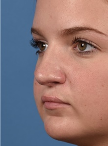 Rhinoplasty After Photo by Christopher Derderian, MD; Dallas, TX - Case 47671