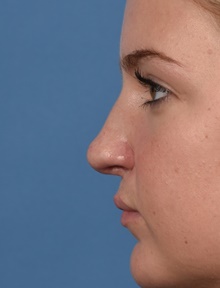 Rhinoplasty After Photo by Christopher Derderian, MD; Dallas, TX - Case 47671