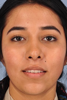 Rhinoplasty After Photo by Christopher Derderian, MD; Dallas, TX - Case 47673