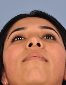 Rhinoplasty After Photo by Christopher Derderian, MD; Dallas, TX - Case 47673