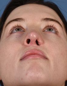 Rhinoplasty After Photo by Christopher Derderian, MD; Dallas, TX - Case 47674