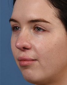 Rhinoplasty After Photo by Christopher Derderian, MD; Dallas, TX - Case 47674