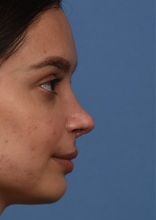 Rhinoplasty After Photo by Christopher Derderian, MD; Dallas, TX - Case 47675