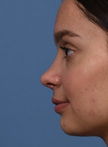 Rhinoplasty After Photo by Christopher Derderian, MD; Dallas, TX - Case 47675