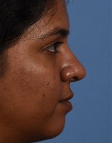 Rhinoplasty After Photo by Christopher Derderian, MD; Dallas, TX - Case 47676