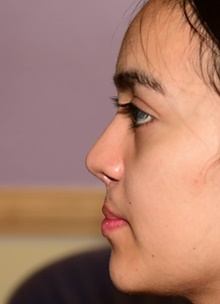 Rhinoplasty After Photo by Christopher Derderian, MD; Dallas, TX - Case 47677