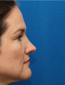 Rhinoplasty After Photo by Christopher Derderian, MD; Dallas, TX - Case 49404