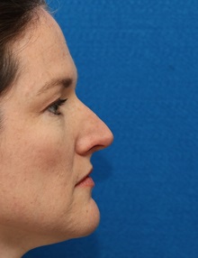 Rhinoplasty Before Photo by Christopher Derderian, MD; Dallas, TX - Case 49404