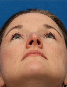 Rhinoplasty Before Photo by Christopher Derderian, MD; Dallas, TX - Case 49404