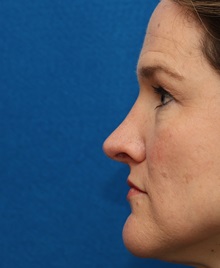 Rhinoplasty After Photo by Christopher Derderian, MD; Dallas, TX - Case 49404