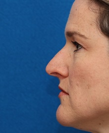 Rhinoplasty Before Photo by Christopher Derderian, MD; Dallas, TX - Case 49404