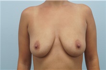 Breast Augmentation Before Photo by Keith Neaman, MD; Salem, OR - Case 31252