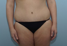 Tummy Tuck After Photo by Keith Neaman, MD; Salem, OR - Case 31621