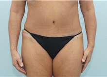 Tummy Tuck After Photo by Keith Neaman, MD; Salem, OR - Case 31623