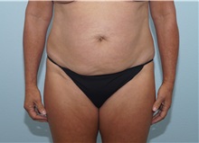 Tummy Tuck Before Photo by Keith Neaman, MD; Salem, OR - Case 31623
