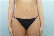 Tummy Tuck After Photo by Keith Neaman, MD; Salem, OR - Case 31628