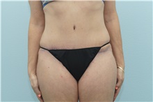 Tummy Tuck After Photo by Keith Neaman, MD; Salem, OR - Case 31629