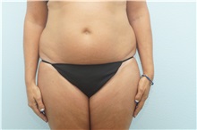 Tummy Tuck Before Photo by Keith Neaman, MD; Salem, OR - Case 31629