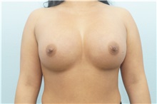 Breast Augmentation After Photo by Keith Neaman, MD; Salem, OR - Case 31632