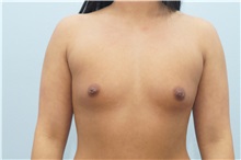 Breast Augmentation Before Photo by Keith Neaman, MD; Salem, OR - Case 31632