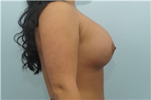 Breast Augmentation After Photo by Keith Neaman, MD; Salem, OR - Case 31632