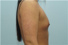 Breast Augmentation Before Photo by Keith Neaman, MD; Salem, OR - Case 31632