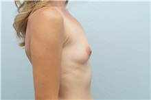 Breast Augmentation Before Photo by Keith Neaman, MD; Salem, OR - Case 31656