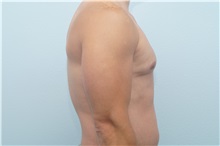 Male Breast Reduction After Photo by Keith Neaman, MD; Salem, OR - Case 31657