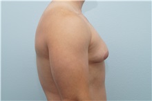 Male Breast Reduction Before Photo by Keith Neaman, MD; Salem, OR - Case 31657