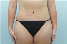 Tummy Tuck After Photo by Keith Neaman, MD; Salem, OR - Case 31660
