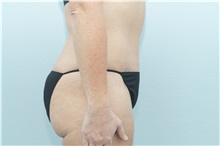 Tummy Tuck After Photo by Keith Neaman, MD; Salem, OR - Case 31660
