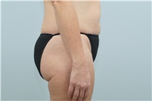 Tummy Tuck Before Photo by Keith Neaman, MD; Salem, OR - Case 31660