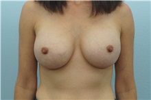 Breast Augmentation After Photo by Keith Neaman, MD; Salem, OR - Case 31661