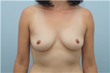Breast Augmentation Before Photo by Keith Neaman, MD; Salem, OR - Case 31661