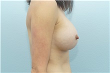 Breast Augmentation After Photo by Keith Neaman, MD; Salem, OR - Case 31661