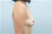 Breast Augmentation Before Photo by Keith Neaman, MD; Salem, OR - Case 31661