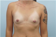Breast Augmentation Before Photo by Keith Neaman, MD; Salem, OR - Case 31662