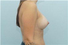 Breast Augmentation After Photo by Keith Neaman, MD; Salem, OR - Case 31662
