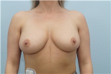 Breast Augmentation Before Photo by Keith Neaman, MD; Salem, OR - Case 31663
