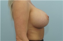 Breast Augmentation After Photo by Keith Neaman, MD; Salem, OR - Case 31663