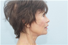 Skin rejuvenation and resurfacing After Photo by Keith Neaman, MD; Salem, OR - Case 31689