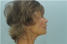 Skin rejuvenation and resurfacing Before Photo by Keith Neaman, MD; Salem, OR - Case 31689