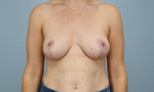 Brow Lift After Photo by Keith Neaman, MD; Salem, OR - Case 50271