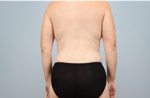 Mommy Makeover After Photo by Keith Neaman, MD; ,  - Case 50274