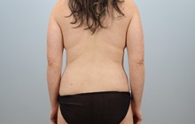 Mommy Makeover Before Photo by Keith Neaman, MD; ,  - Case 50274