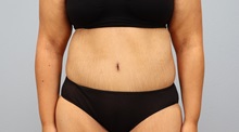 Tummy Tuck After Photo by Keith Neaman, MD; ,  - Case 50275